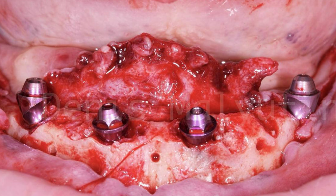 Four angled abutments secured to dental implants in mandible with exposed surgical site