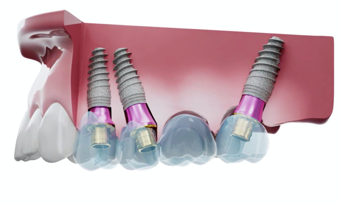 Cross-sectional model showing three dental implants with angled abutments compensating for implant angulation in jaw
