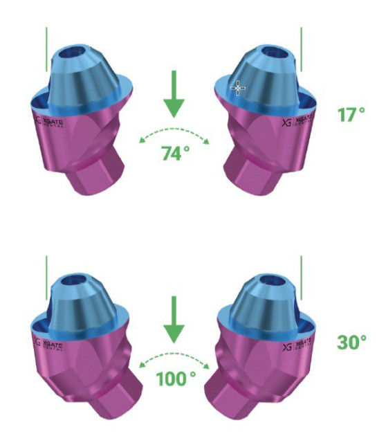 Angled multi‑unit abutments by XGATE Dental compensate implant divergence: 17° → 74°, 30° → 100°