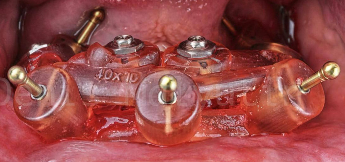 Four multi-unit abutments with angled and straight configurations placed on mandibular implants