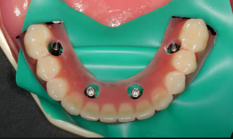 Preliminary attachment of a temporary prosthesis to cylinders