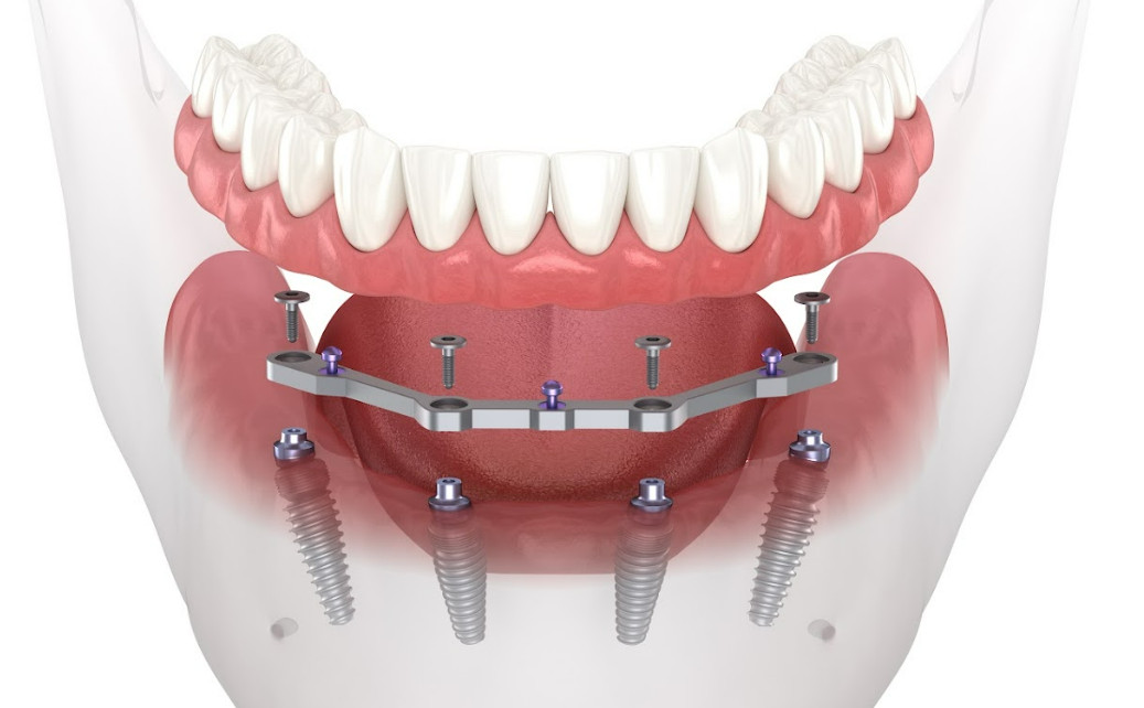 An example of implant-supported bar prosthetics