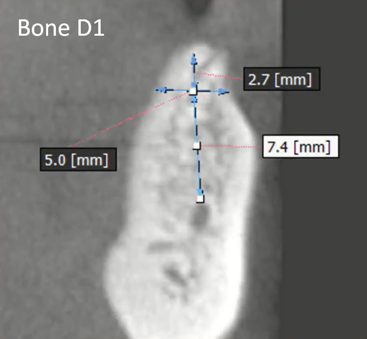 D1 bone density implant planning with measurement markers showing 2.7mm, 5.0mm, and 7.4mm dimensions