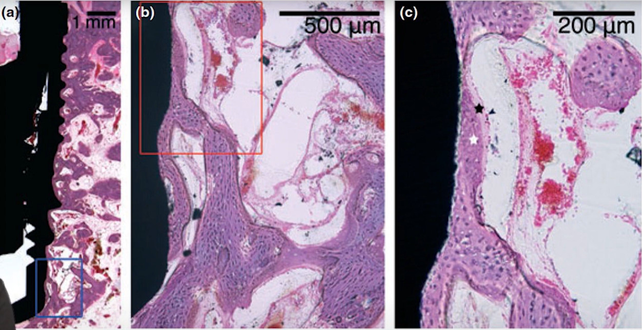 Microscopic view of bone formation around dental implant surface and fragments