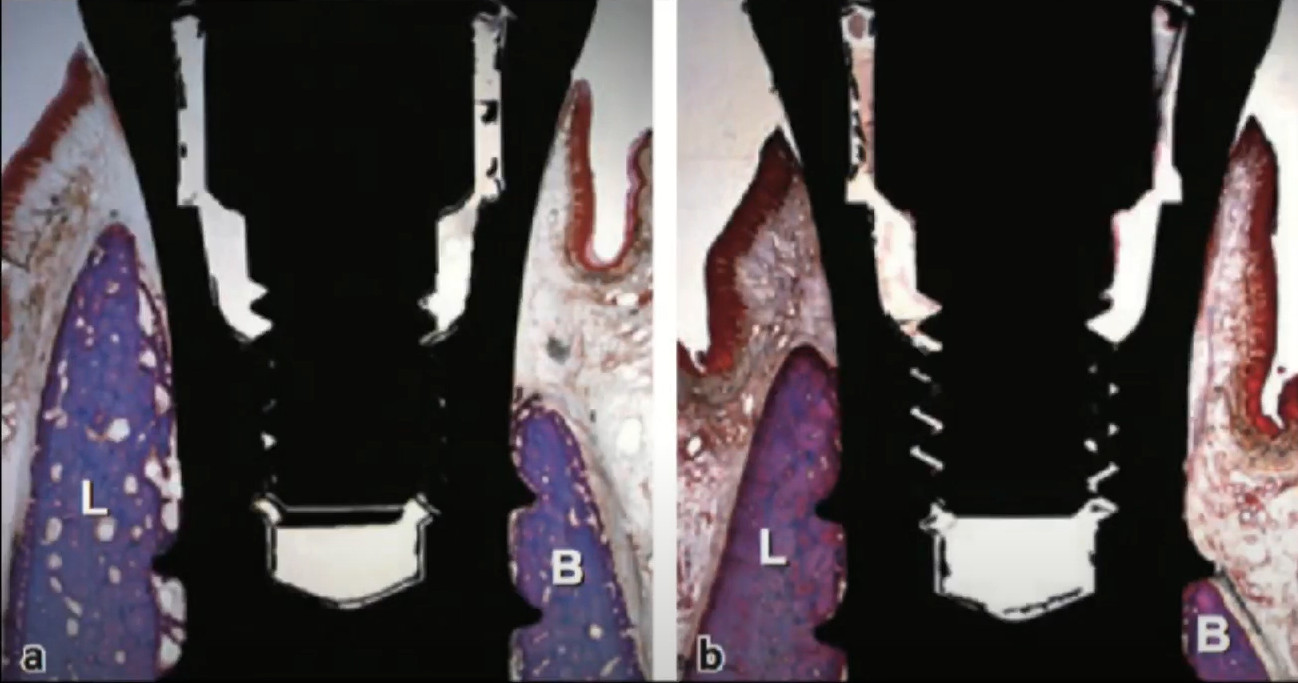 Results of bone resorption around the implant neck