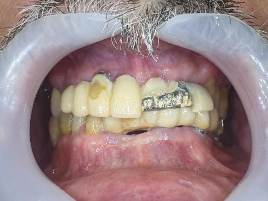 Initial situation: damaged upper bridge with a pigmented spot on the composite covering the screw shaft; significant wear and loss of aesthetics on the lower bridge