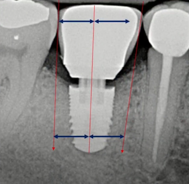 Bridges with screw retention 1
