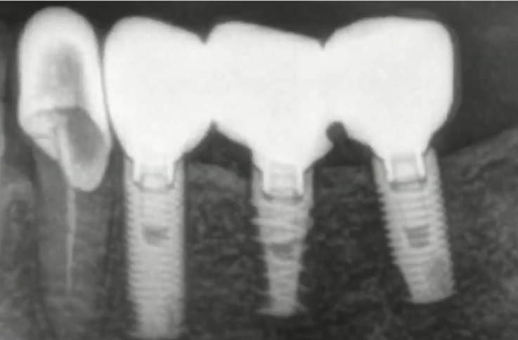 There are two bridges with screw retention and in both cases there are visible problems with the fit; there are noticeable gaps in between the internal hex and the implant body