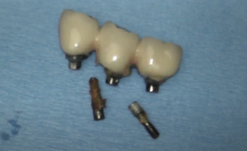 Broken denture due to misfit of restoration