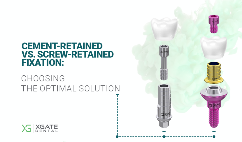 Cement or Screw Retention for Implant Prosthetics