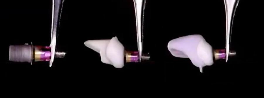 Extraoral cementation of the final crown onto the custom abutment.