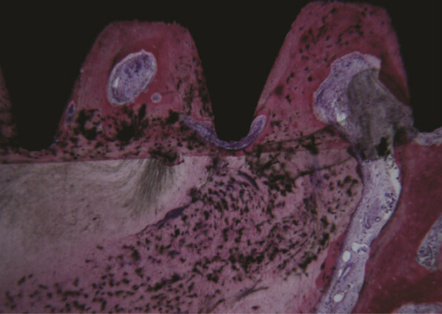 In the apical portion of the root, it was observed that the cementum migrated from the residual root to the implant surface. Acid fuchsin-toluidine blue 40x. YouTube / Dr. Kamil Khabiev / Dental Guru Academy