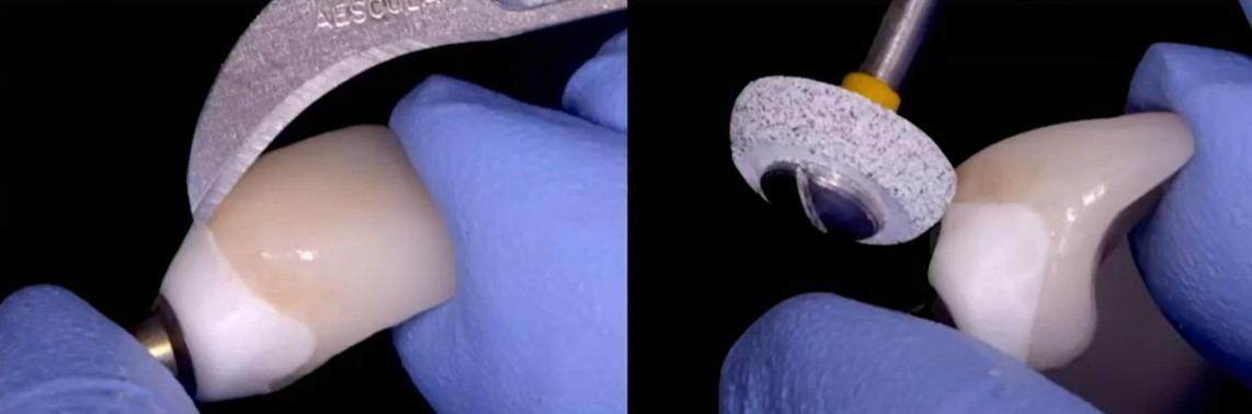 Close-up of the cleaned and polished implant-abutment transition zone before delivery.