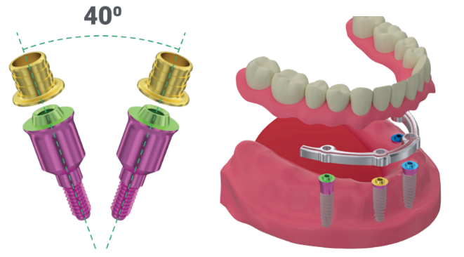 Color-coded multi-unit abutments for dental implant prosthetics by gingival height