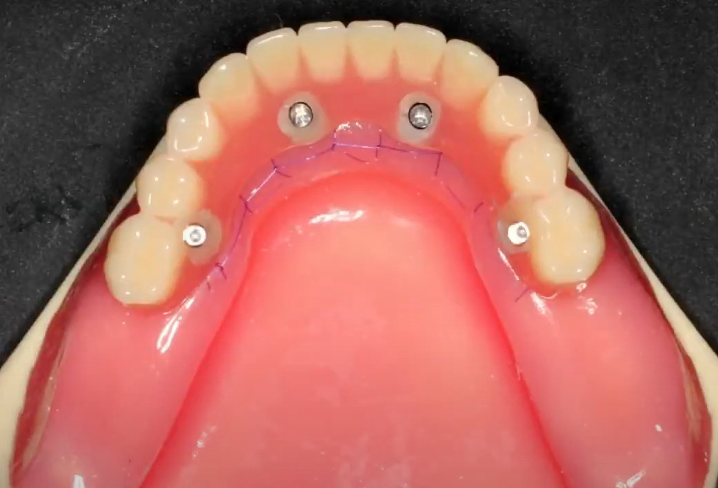 The finished educational project is secured on the jaw model