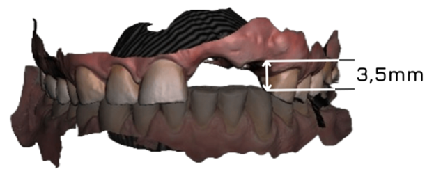Dental implant spacing issue with insufficient clearance to opposing teeth