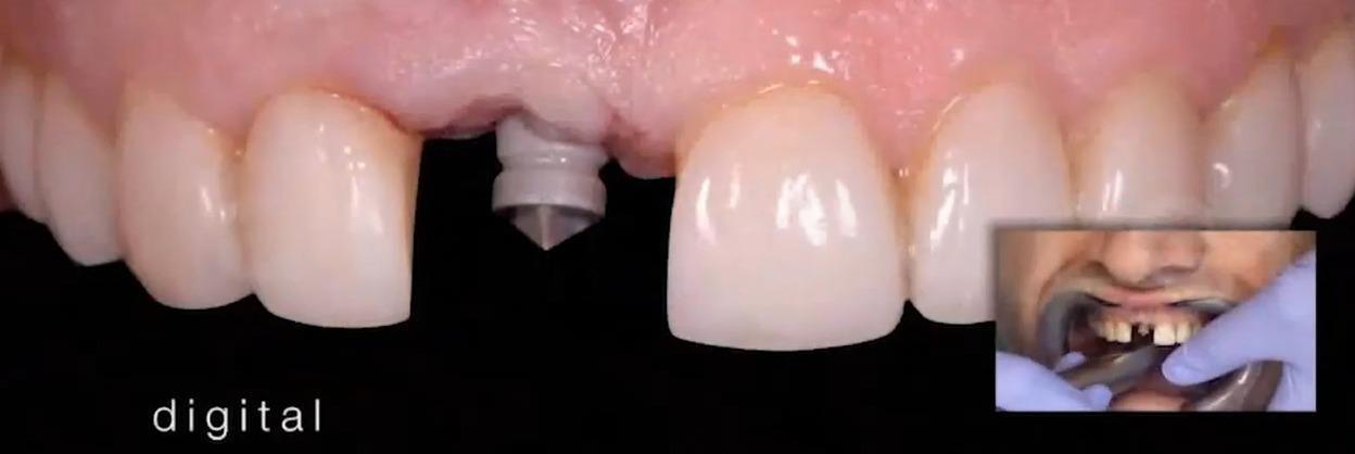 Clinical image of the scan body in place during digital impression capture.