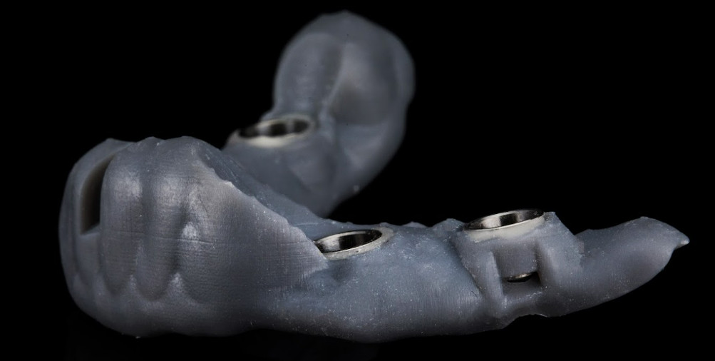 Custom 3D-printed surgical guide with metal drill sleeves photographed on a black background.