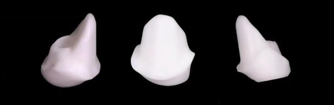 Milled custom abutment fabricated for restoration of the maxillary central incisor.