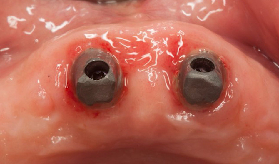 Two gray titanium dental implant abutments secured in jaw bone tissue