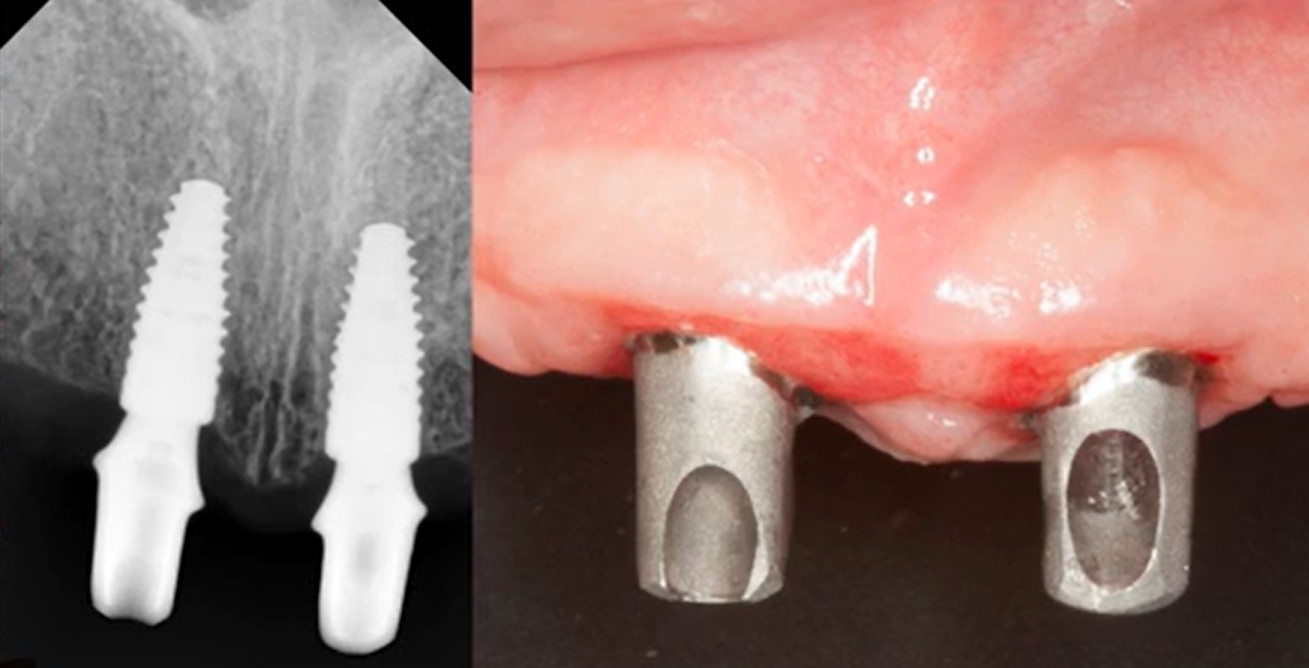 Two dental implant abutments positioned on lower jaw showing frontal view during try-in stage