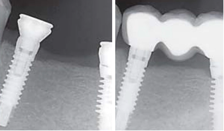 X-ray comparison showing dental implant bone levels at placement and after twelve months