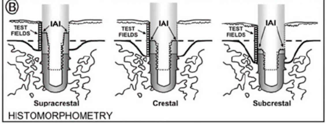 Histomorphometry diagram showing three dental implant placement depths: supracrestal, crestal, and subcrestal with corresponding bone loss patterns