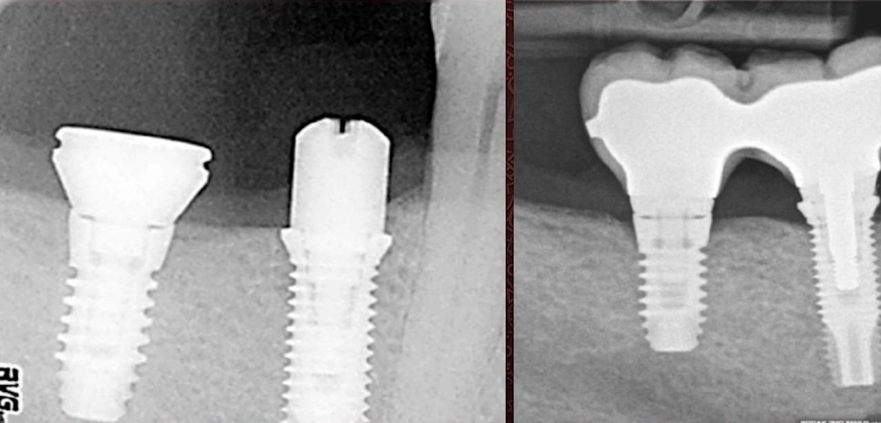 X-ray comparison showing dental implant bone loss progression from placement to twelve months