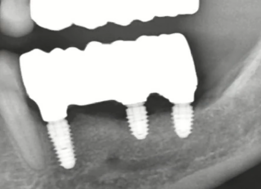 Dental x-ray showing three dental implants with visible bone resorption around implant necks