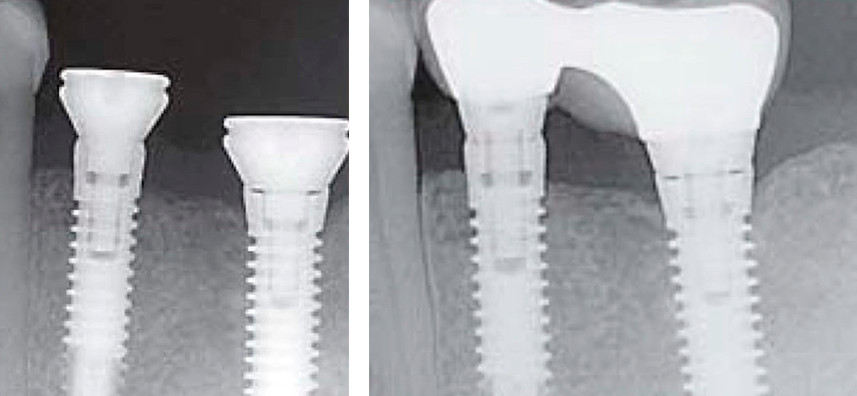 X-ray comparison showing dental implant bone levels at placement and after 12 months with preserved marginal bone