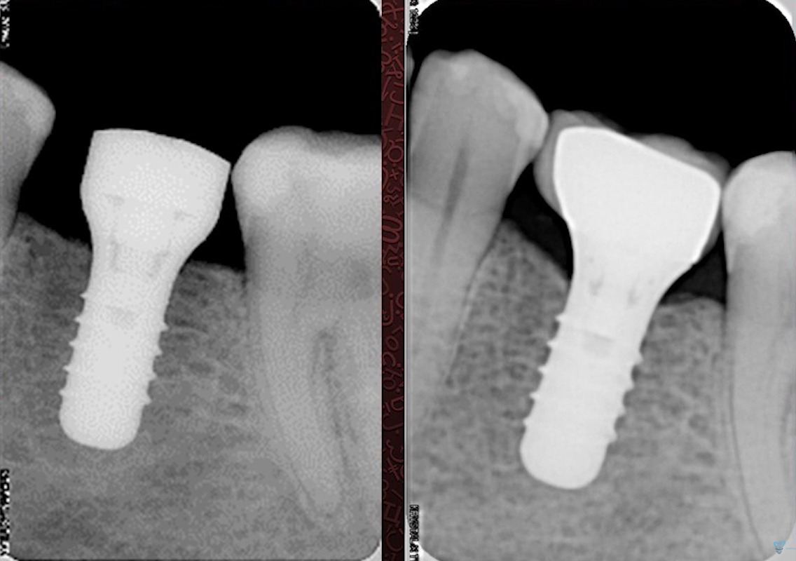 Two periapical radiographs comparing dental implant bone levels at placement and twelve months later showing marginal bone loss
