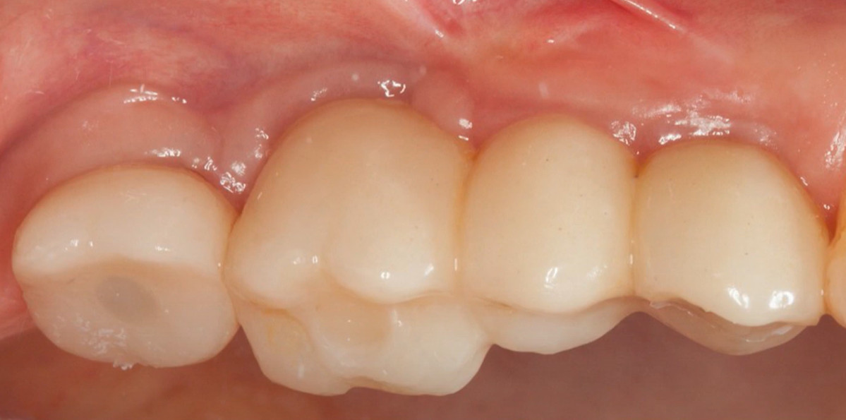 Healthy gingival tissues around dental implant bridge and crown restoration post-treatment