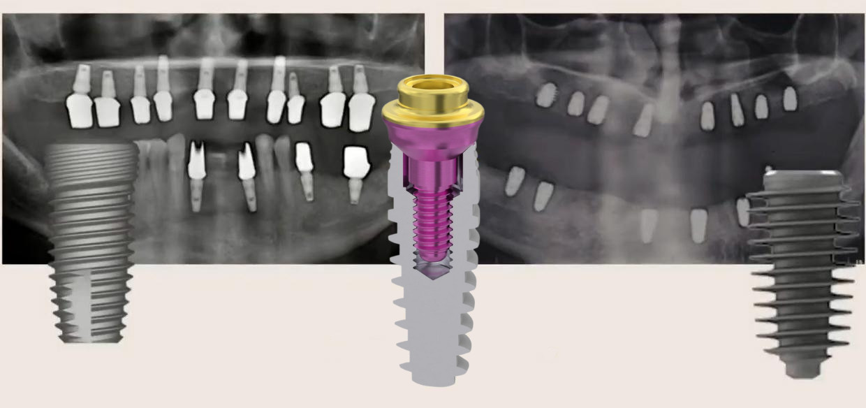 Three dental implant designs displayed against dental x-ray showing cortical, universal, and cancellous implant types