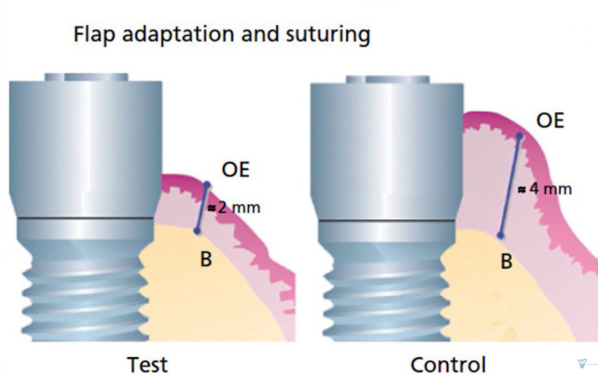 Comparison diagram showing gingival tissue thickness around dental implant at 2mm versus 4mm with oral epithelium and bone labeled