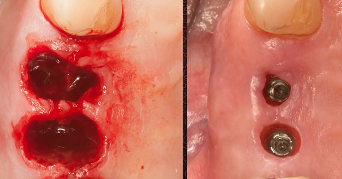 Before and after comparison showing dental implant surgical sites with healing abutments and healthy attached gingiva tissue