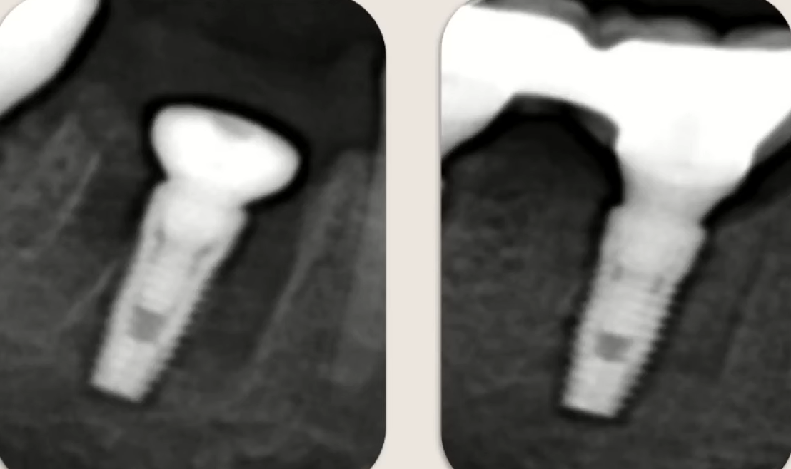 CBCT scans showing dental implant placed in interradicular septum before and after integration