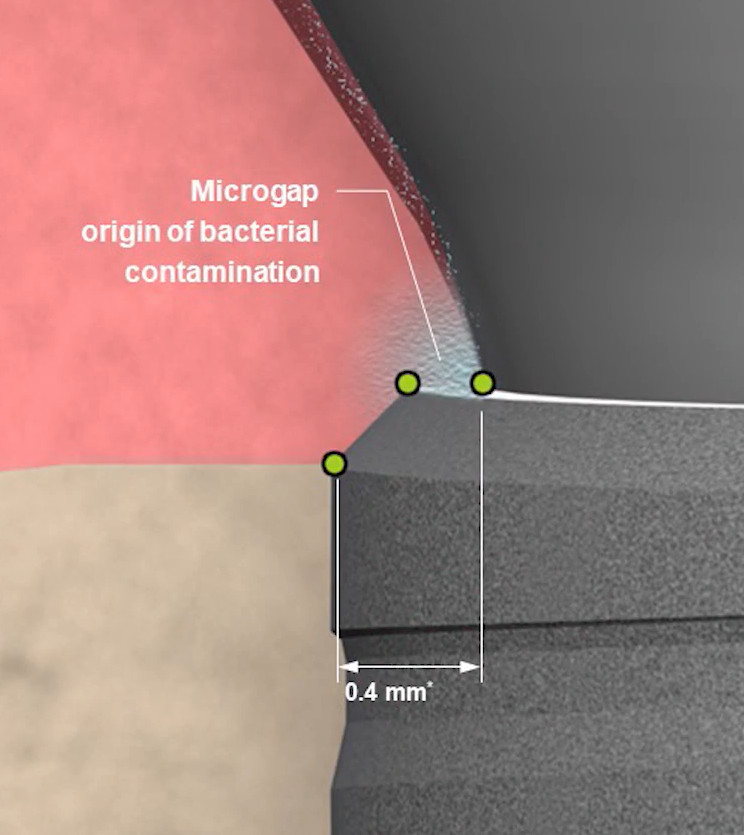 Diagram showing 0.4mm microgap at dental implant junction allowing bacterial contamination