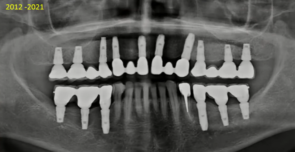 Panoramic dental x-ray showing multiple dental implants in upper and lower jaw with minimal bone loss after nine years