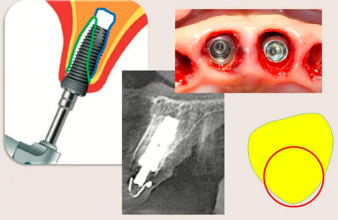Four images showing dental implant placement methods including surgical diagram, clinical placement photo, x-ray view, and positioning schematic