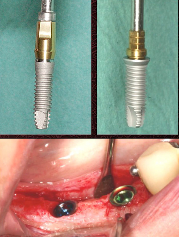 Two dental implant abutments showing platform switching differences and surgical placement in jaw bone with adjacent tooth