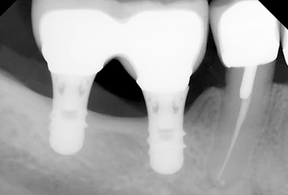 X-ray showing two tissue level dental implants with minimal bone loss and healthy integration