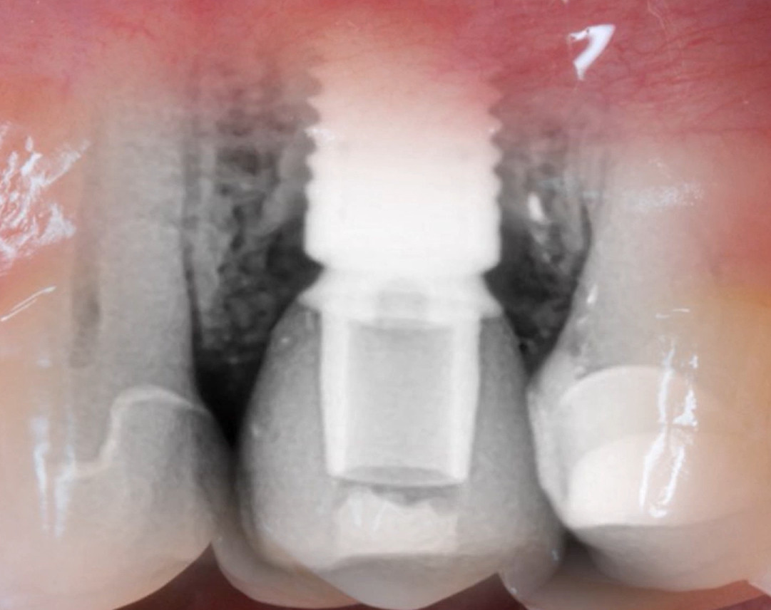 Overlay of dental radiograph and clinical photo showing dental implant with visible bone loss around restoration
