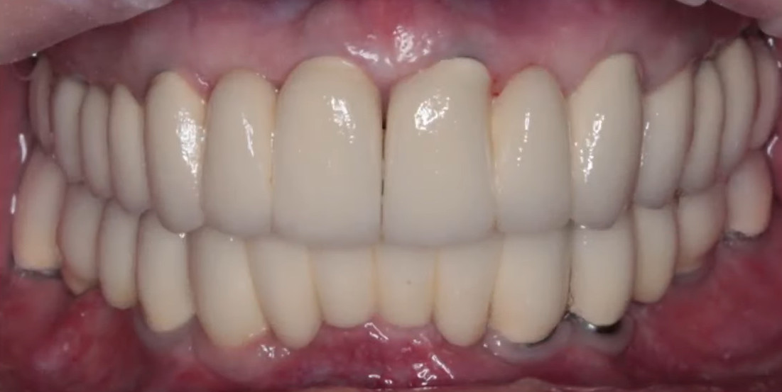 Full arch dental implant restoration showing healed results with visible abutment collars and minor gingival recession