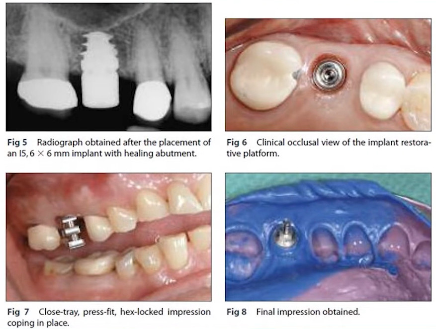 Four stage dental implant process showing radiograph, healing abutment, impression coping, and final impression