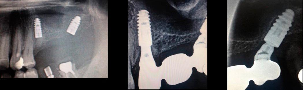 Three sequential dental x-rays showing implant placement and crown restoration stages