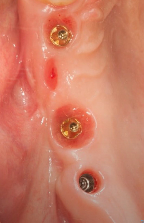 Dental implant healing cap examination before bridge and crown restoration