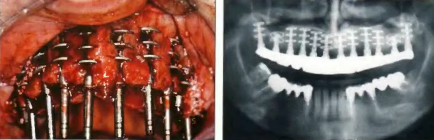 Dental implant complications showing inadequate spacing between adjacent implants