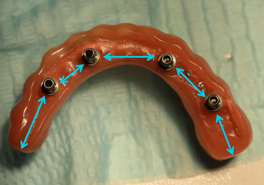 Full-arch dental prosthesis showing optimal implant spacing with blue arrows indicating distances between attachment points