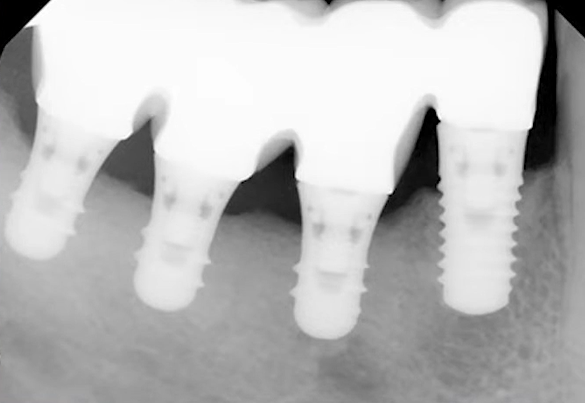 Dental x-ray showing four dental implants integrated into jawbone structure