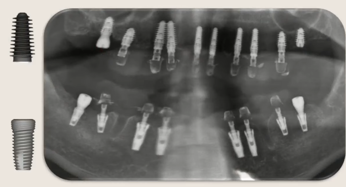 Panoramic dental x-ray showing multiple dental implants placed in upper and lower jaw